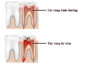 Điều trị tủy răng cho bé sao cho hiệu quả và cách phòng ngừa viêm tủy