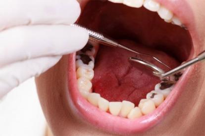 Bệnh sâu răng và phương pháp điều trị?