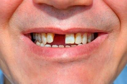 Sau khi nhổ răng không trồng lại răng có được không?
