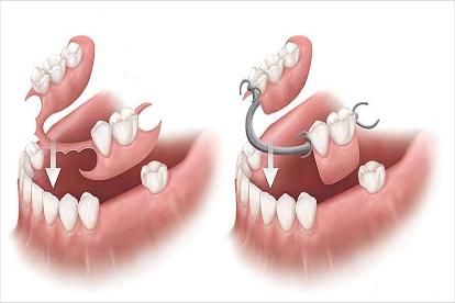 Phục hình răng mất bằng răng tháo lắp liệu có hiệu quả không?