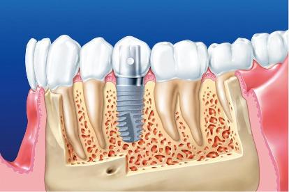 Bị mất răng hàm có cấy ghép Implant được không?